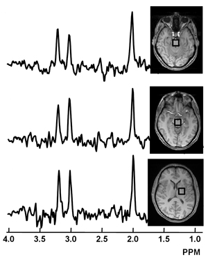 ALS MRS whole brain prefALS