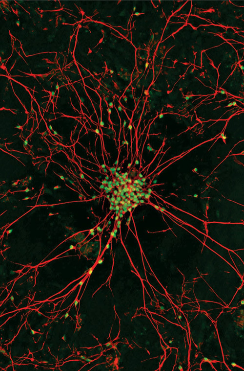 reprogrammed stem cell induced pluripotent iPS ALS MND