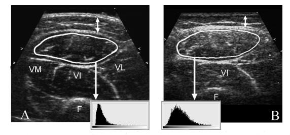 neuromuscular ultrasound NMUS DMD