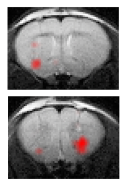 neural stem cell neuralstem als mnd